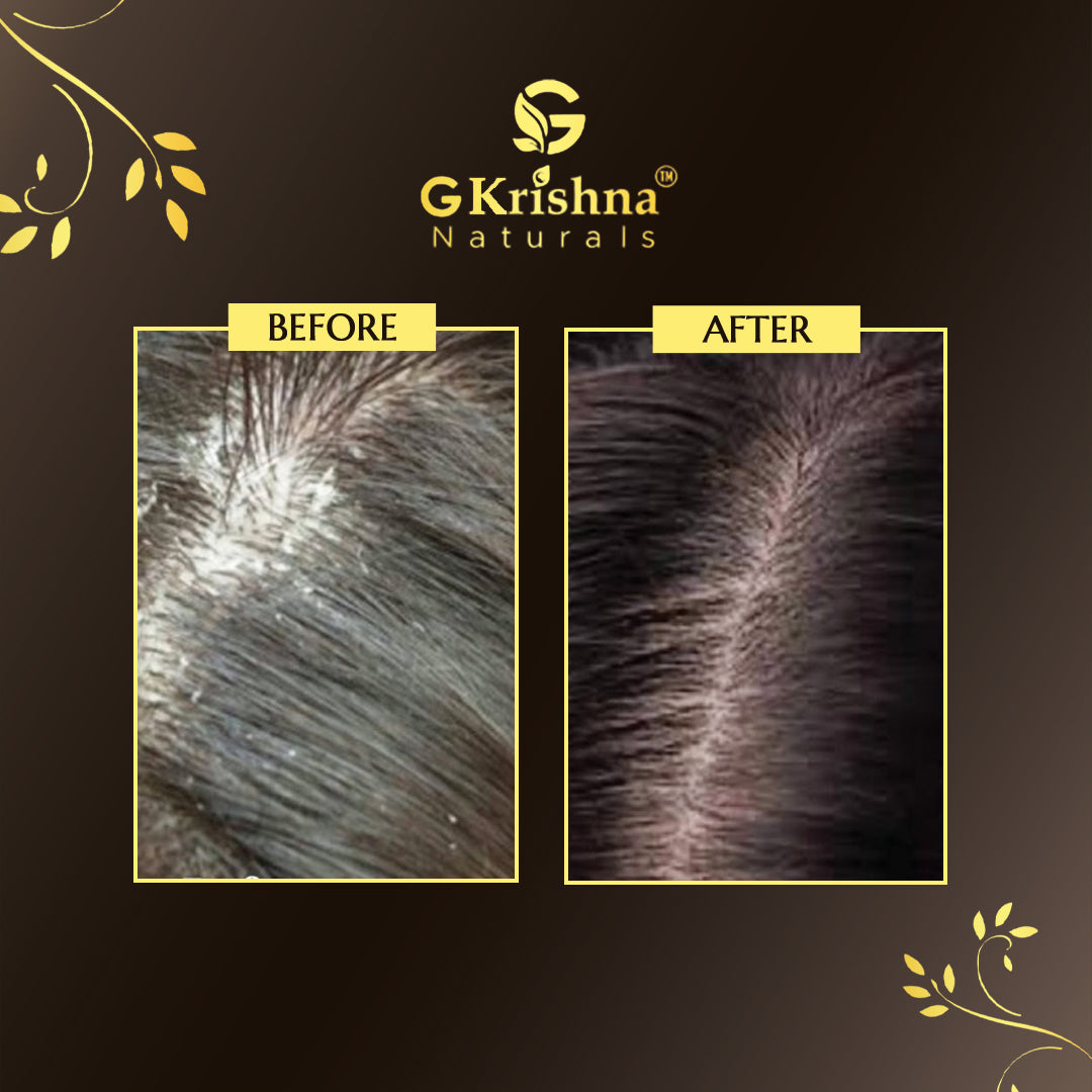 Advanced Anti-Dandruff Kit