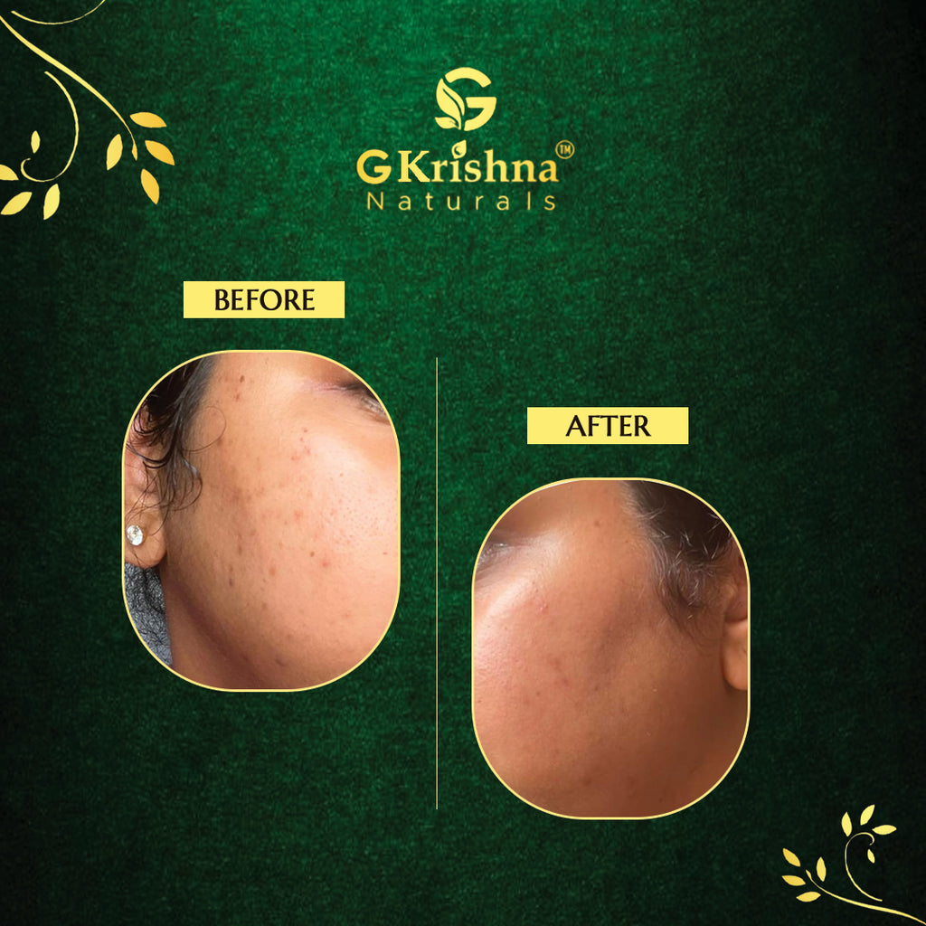 Anti-Acne Gel