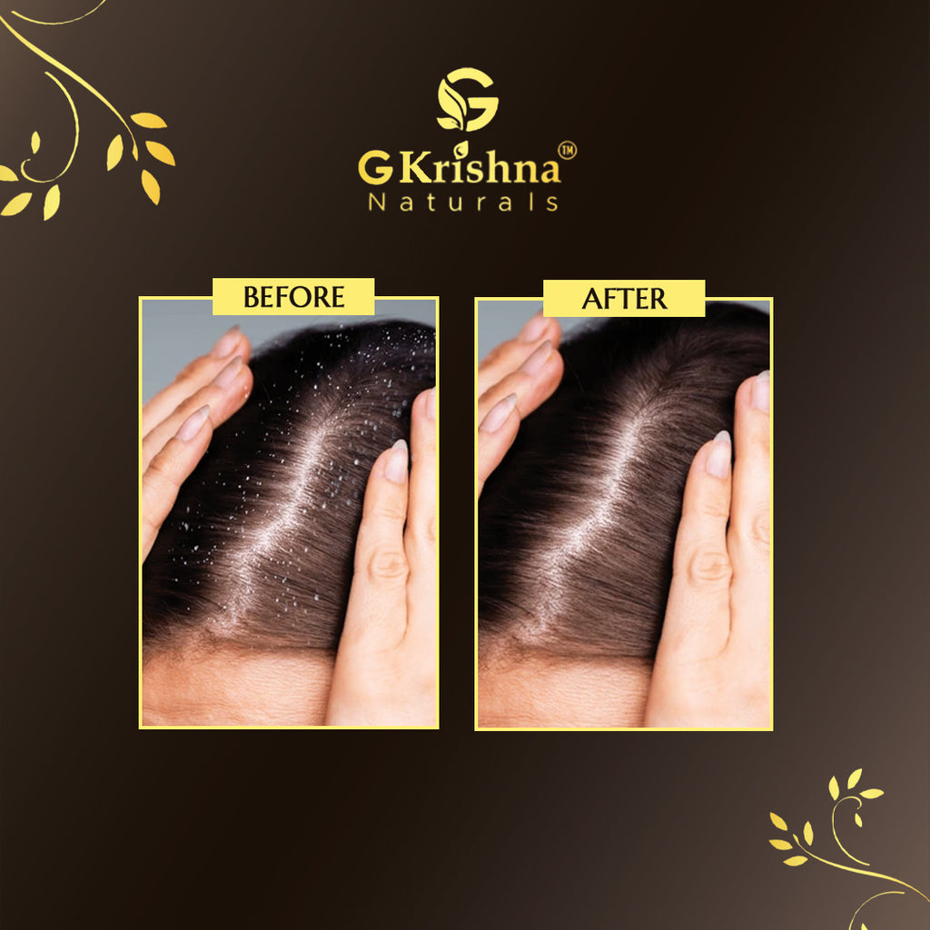Anti Dandruff Gel