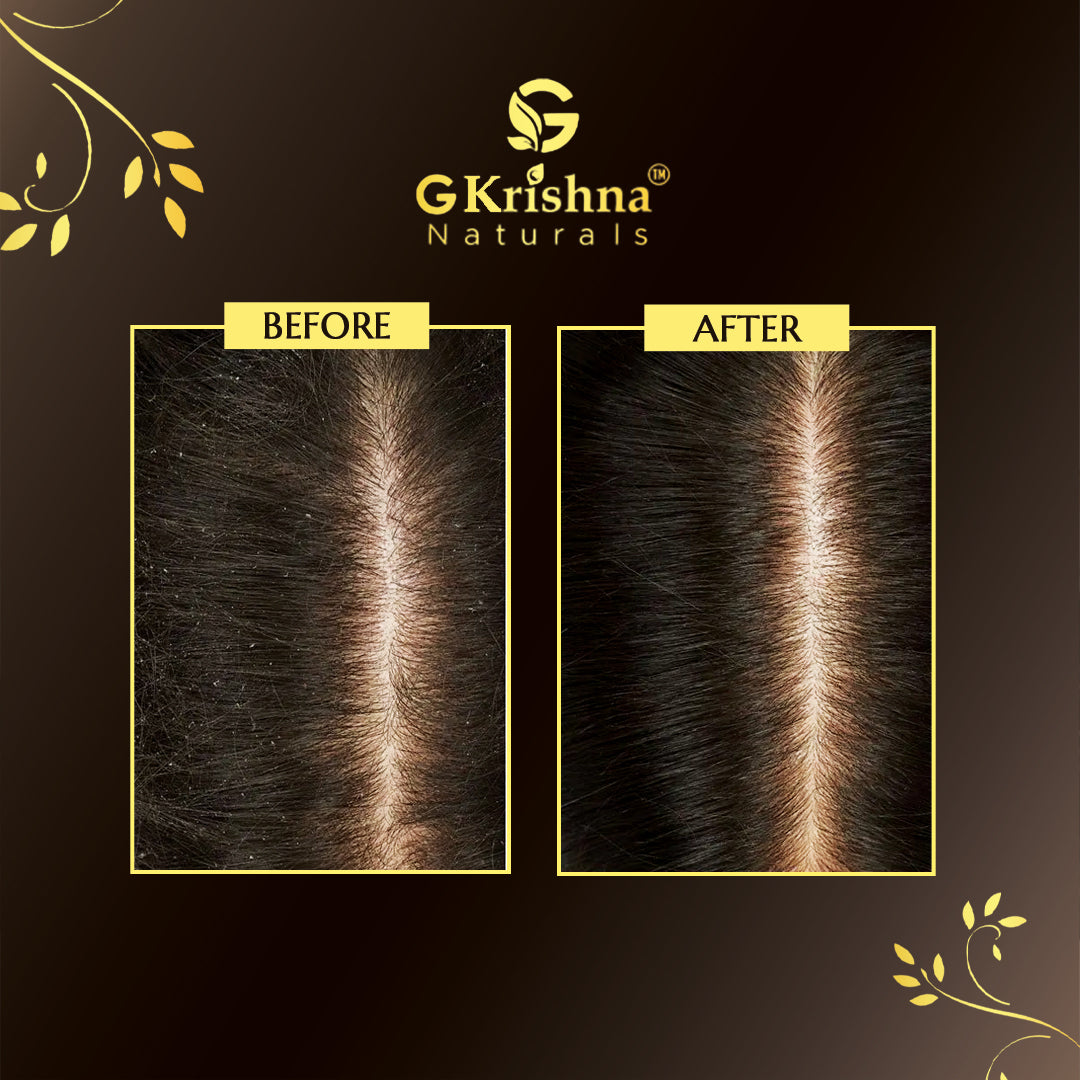 Anti Dandruff Shampoo