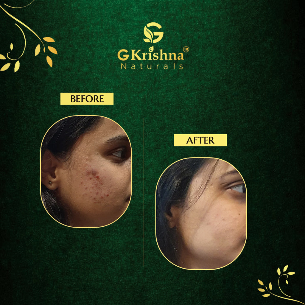 Anti-Pimple Gel