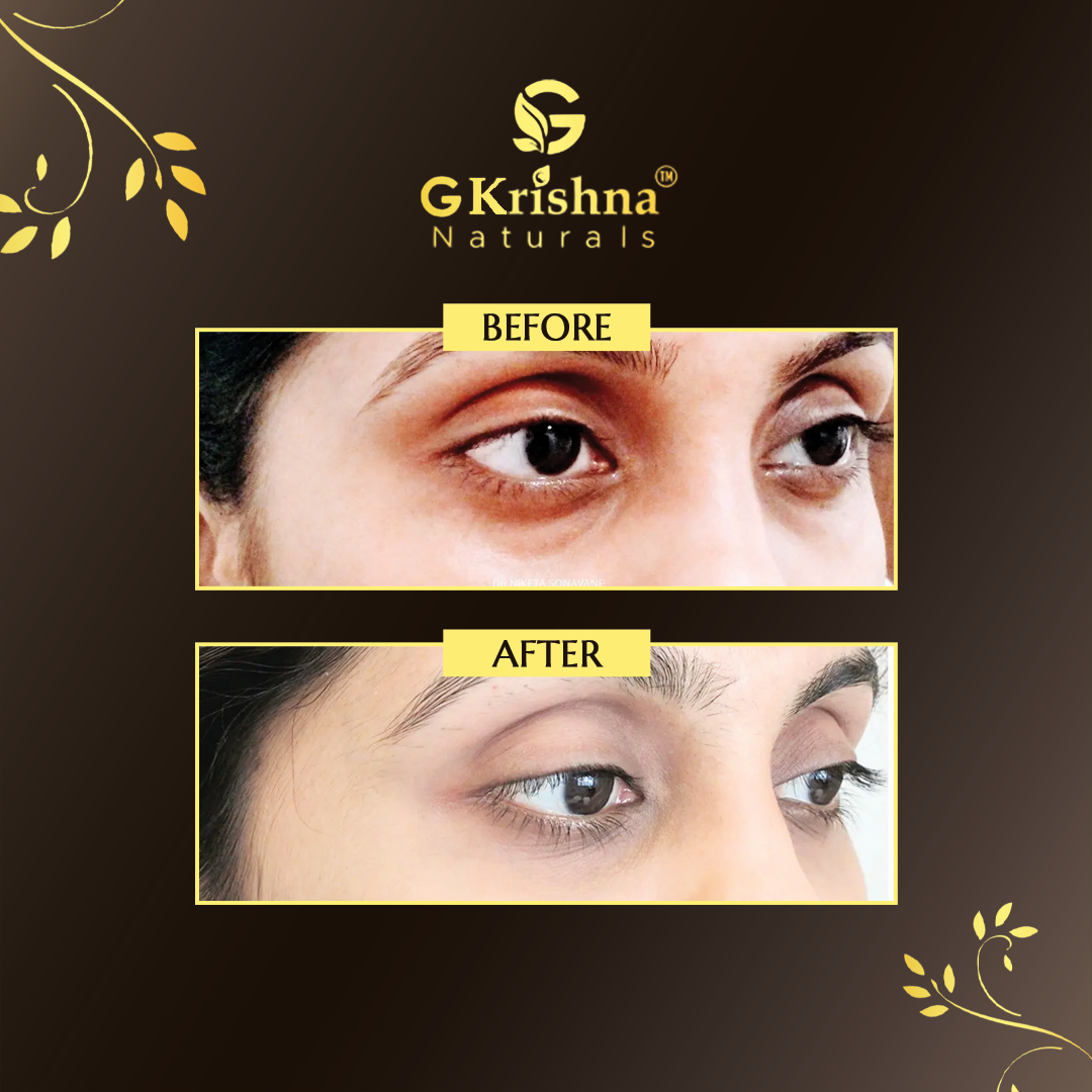 Under Eye Gel for Dark Circles